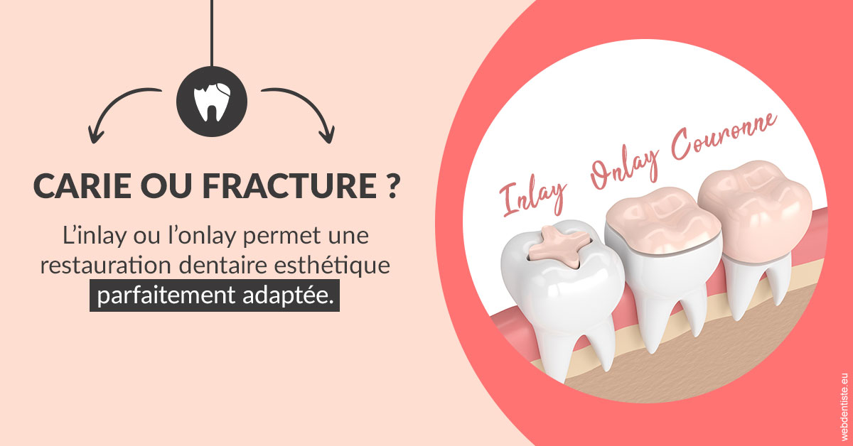 https://cabinetdentairelumiere.fr/T2 2023 - Carie ou fracture 2