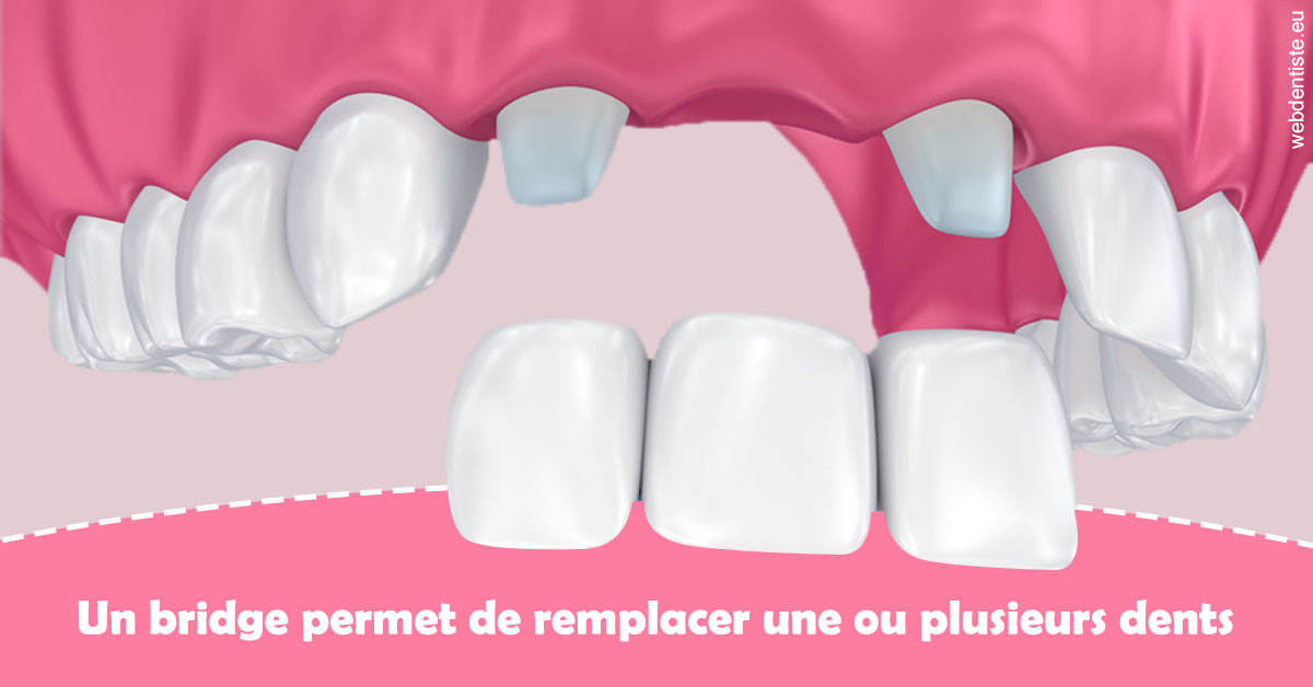 https://cabinetdentairelumiere.fr/Bridge remplacer dents 2