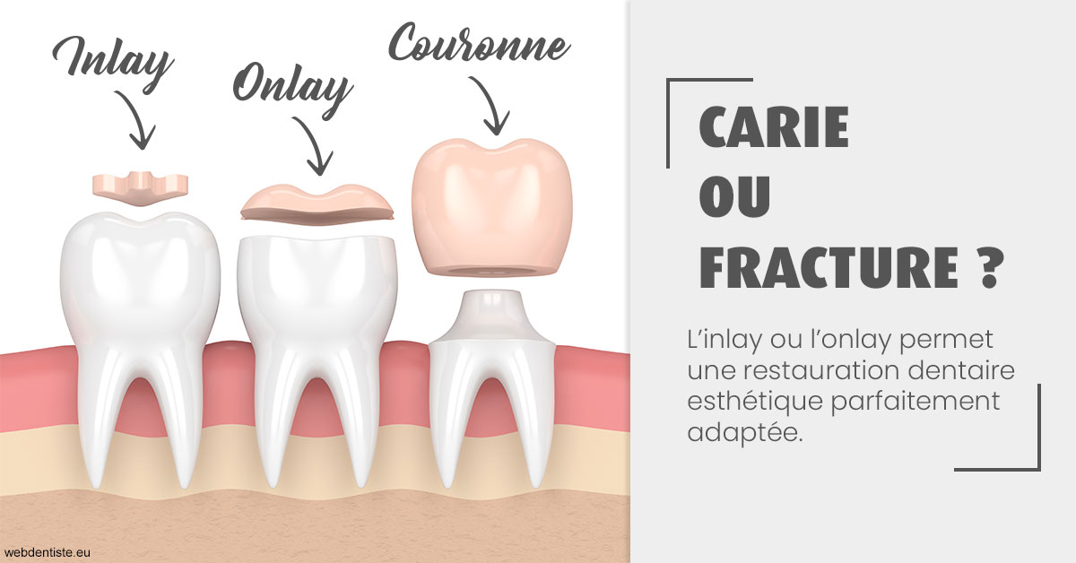 https://cabinetdentairelumiere.fr/T2 2023 - Carie ou fracture 1
