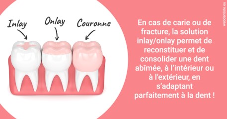 https://cabinetdentairelumiere.fr/L'INLAY ou l'ONLAY 2