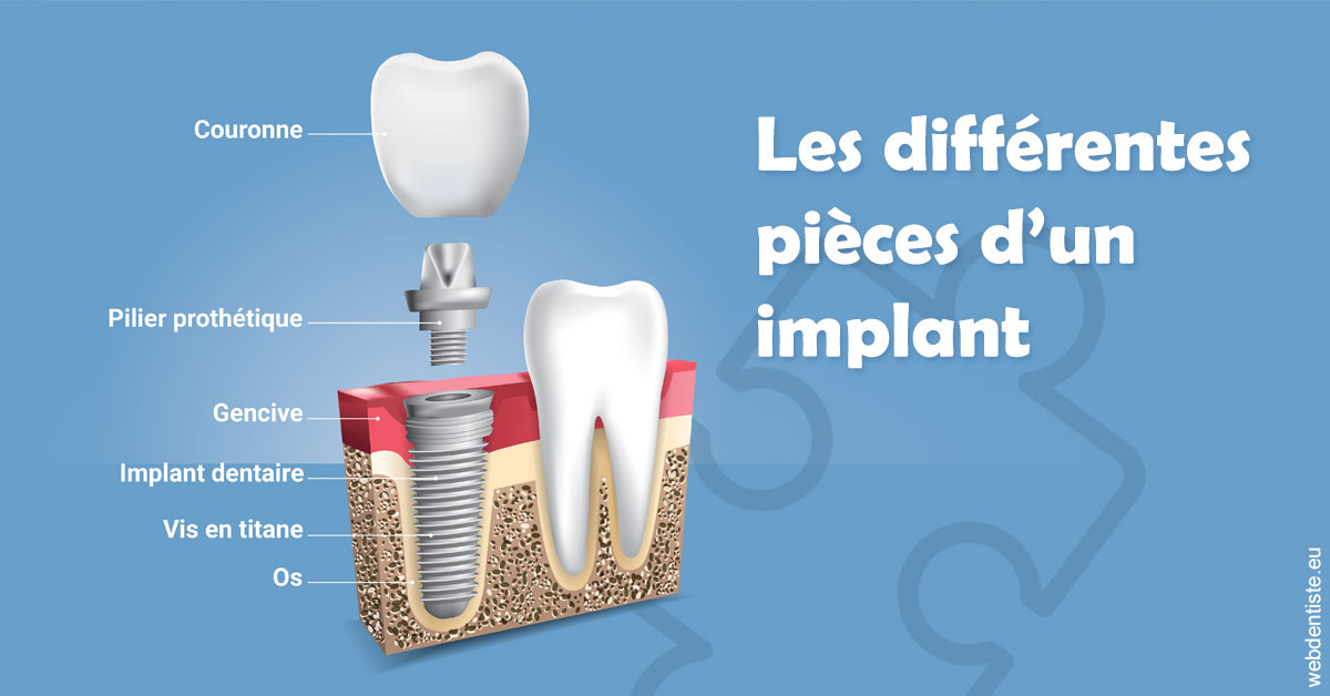 https://cabinetdentairelumiere.fr/Les différentes pièces d’un implant 1