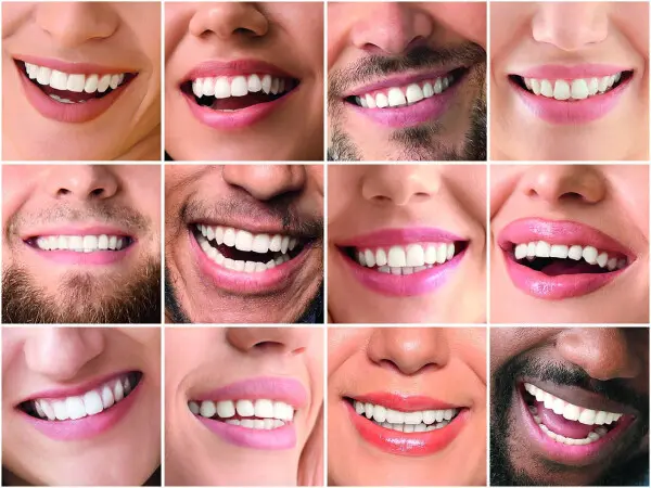 Ligne du sourire