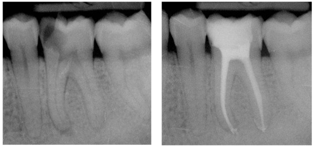 Traitements endodontiques2
