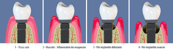 peri-implantite-bandeau