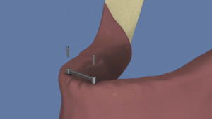 Stabilisation d'une prothèse par une barre sur 2 implants