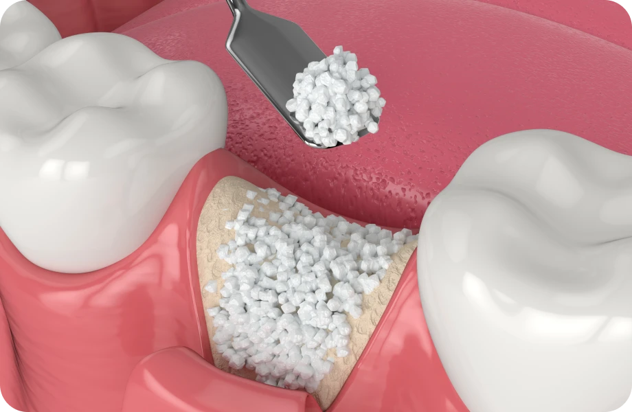 chirurgie dentaire lyonReconstruction osseuseChirurgiens-dentistes Lyon 3 |   Cabinet Lumière