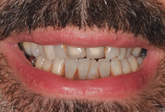 extraction dentaire chirurgicale lyonCas 2Chirurgiens-dentistes Lyon 3 |   Cabinet Lumière