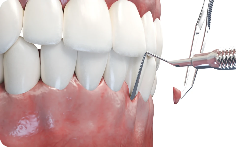 extraction dentaire lyonGreffe gingivaleChirurgiens-dentistes Lyon 3 |   Cabinet Lumière
