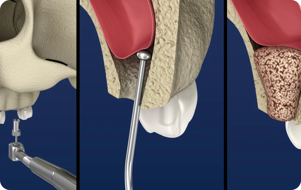 extraction implantaire lyonReconstruction osseuseChirurgiens-dentistes Lyon 3 |   Cabinet Lumière