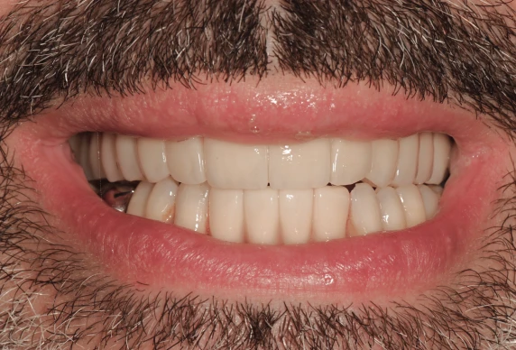 extraction implantaire lyonCas 2Chirurgiens-dentistes Lyon 3 |   Cabinet Lumière