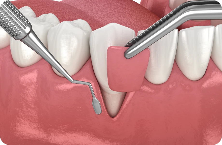 greffe gingivale lyonGreffe gingivaleChirurgiens-dentistes Lyon 3 |   Cabinet Lumière