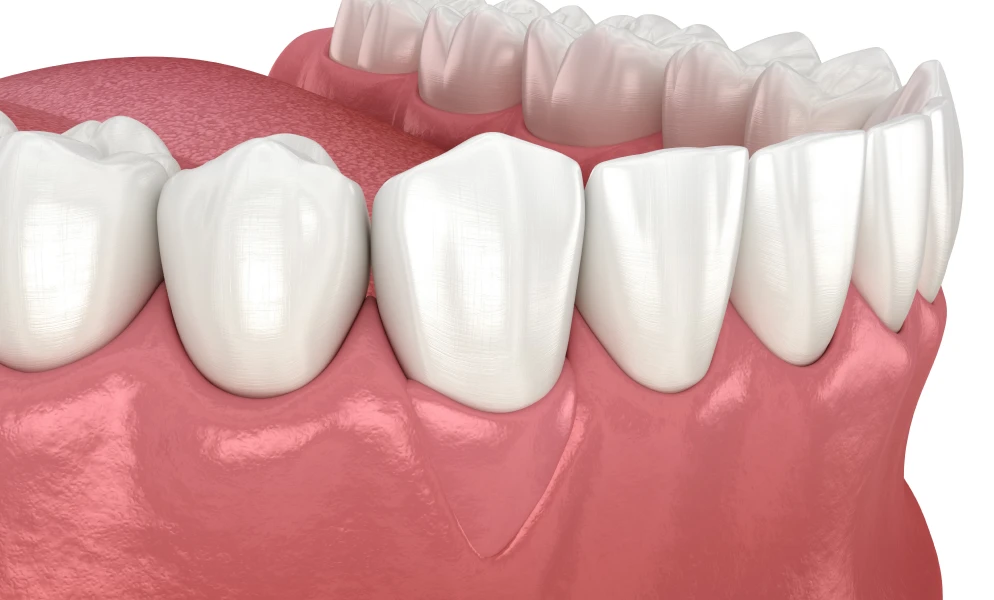 greffe gingivale lyon drs berdougo valbrayGreffe gingivaleChirurgiens-dentistes Lyon 3 |   Cabinet Lumière