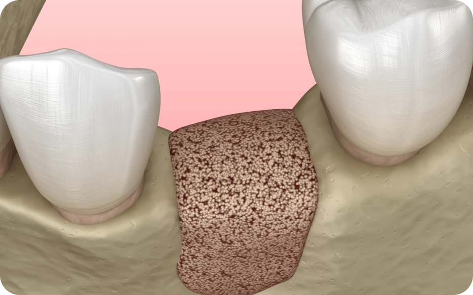 greffe osseuse lyonReconstruction osseuseChirurgiens-dentistes Lyon 3 |   Cabinet Lumière