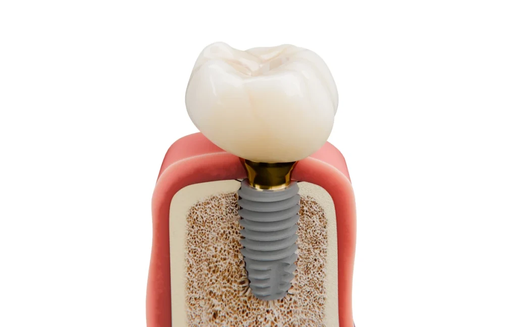 implant dentaire cabinet lumiereImplant unitaireChirurgiens-dentistes Lyon 3 |   Cabinet Lumière