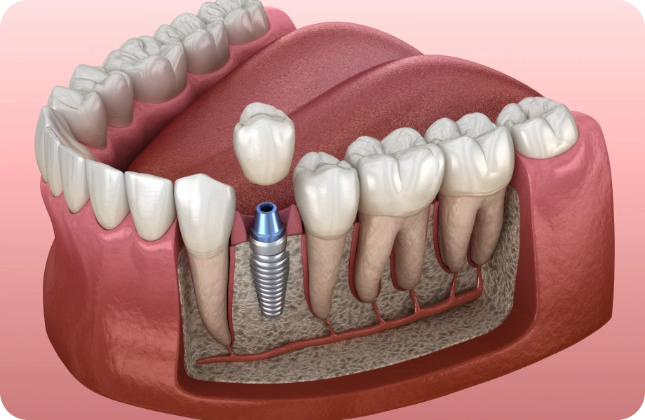 implant dentaire lyonImplant unitaireChirurgiens-dentistes Lyon 3 |   Cabinet Lumière