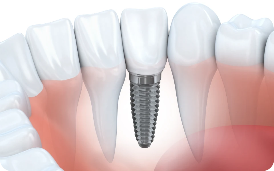 implant dentaire lyon dentisteImplant unitaireChirurgiens-dentistes Lyon 3 |   Cabinet Lumière
