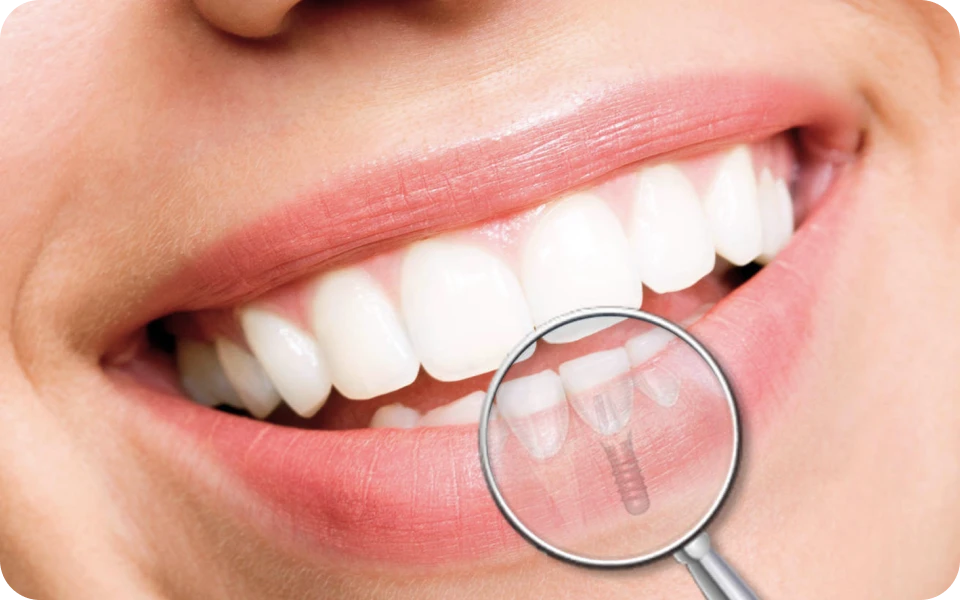 implant lyonImplant unitaireChirurgiens-dentistes Lyon 3 |   Cabinet Lumière