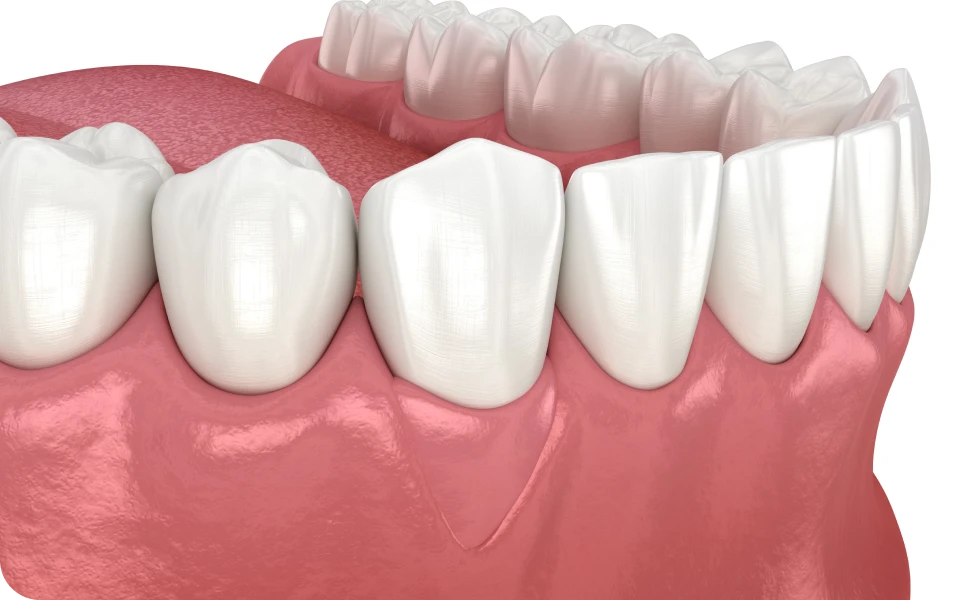 implants sous periostes lyonGreffe gingivaleChirurgiens-dentistes Lyon 3 |   Cabinet Lumière