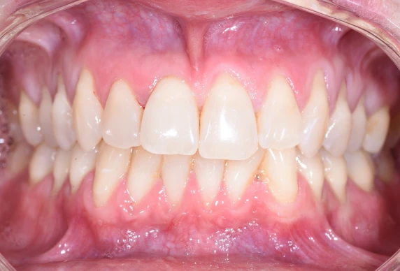 prothese complete lyonCas 1Chirurgiens-dentistes Lyon 3 |   Cabinet Lumière
