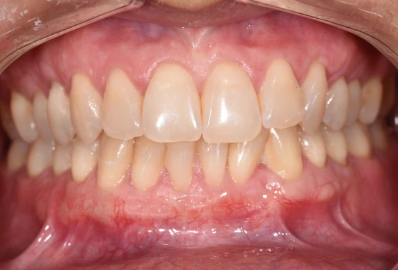 prothese stabilisee implants lyonCas 1Chirurgiens-dentistes Lyon 3 |   Cabinet Lumière