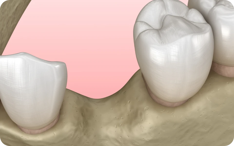 reconstruction osseuse lyonReconstruction osseuseChirurgiens-dentistes Lyon 3 |   Cabinet Lumière