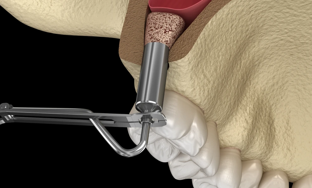 sinus lift lyon drs berdougo valbrayReconstruction osseuseChirurgiens-dentistes Lyon 3 |   Cabinet Lumière