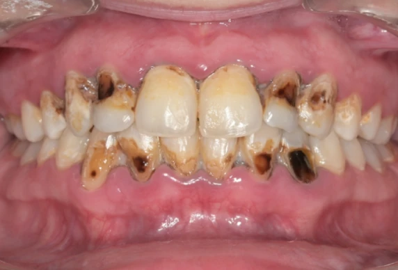 chirurgie osseuse lyonCas 3Chirurgiens-dentistes Lyon 3 |   Cabinet Lumière