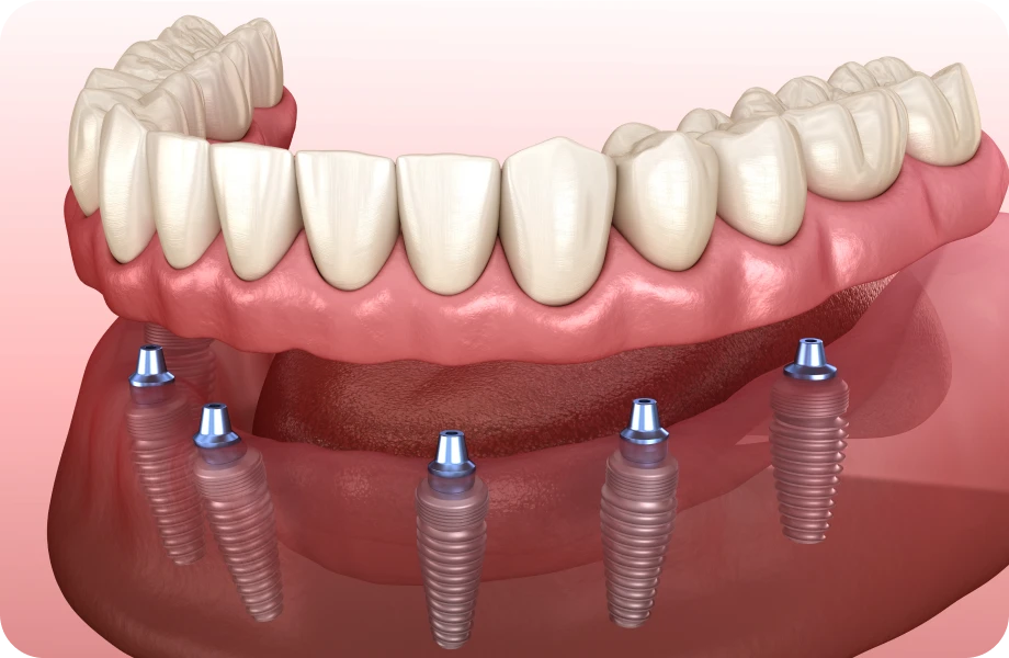 prothese fixe lyonProthèse fixe sur implantChirurgiens-dentistes Lyon 3 |   Cabinet Lumière
