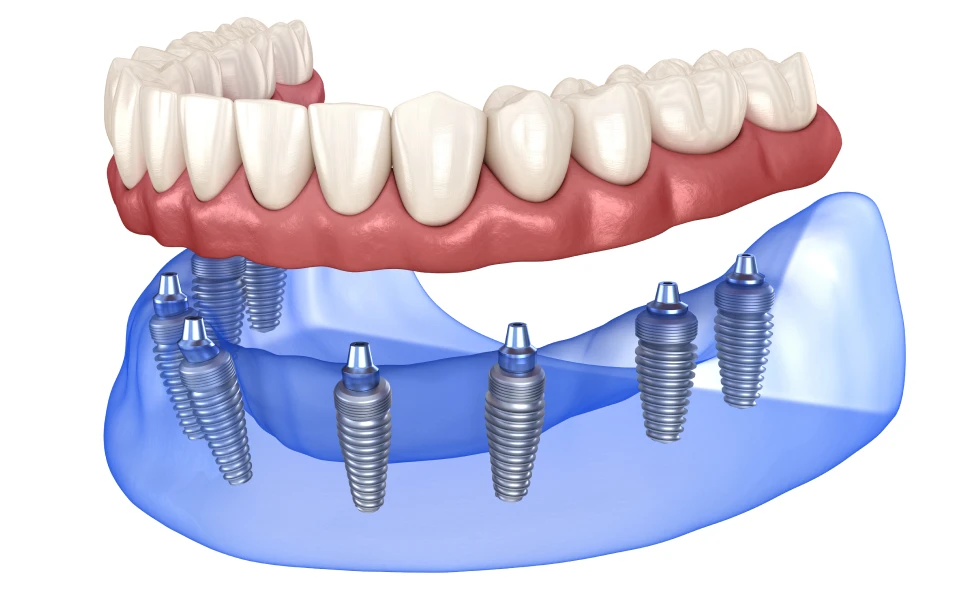 regeneration parodontale lyonProthèse fixe sur implantChirurgiens-dentistes Lyon 3 |   Cabinet Lumière