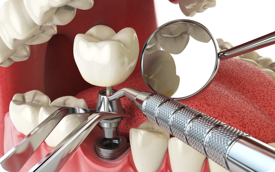 avulsion dentaire visee implantaireExtraction à visée implantaire Chirurgiens-dentistes Lyon 3 |   Cabinet Lumière