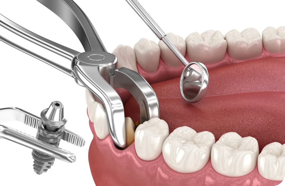chirurgie implantaire lyonExtraction à visée implantaire Chirurgiens-dentistes Lyon 3 |   Cabinet Lumière