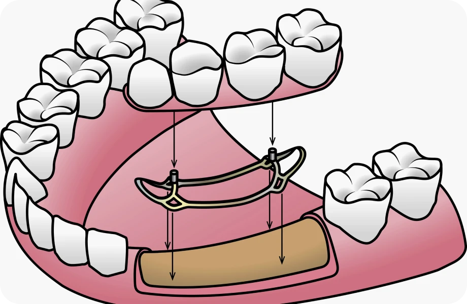 chirurgiens dentistes lyonImplants sous-périostésChirurgiens-dentistes Lyon 3 |   Cabinet Lumière