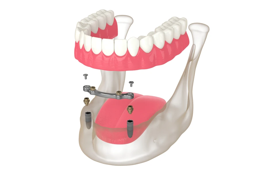 greffe gingivale lyonProthèse amovible complète stabilisée sur implants ( PACSI)Chirurgiens-dentistes Lyon 3 |   Cabinet Lumière