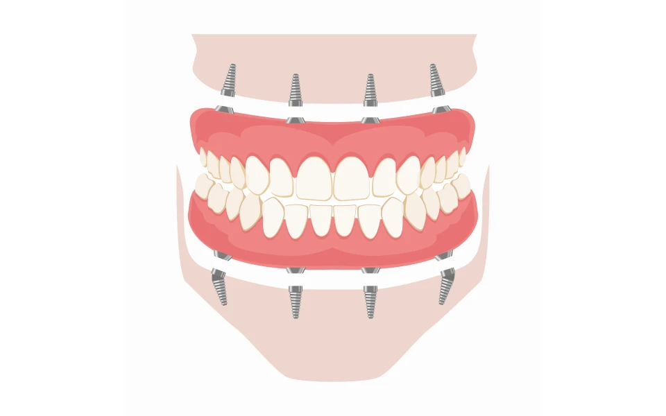 prothese amovible complete stabiliseeProthèse amovible complète stabilisée sur implants ( PACSI)Chirurgiens-dentistes Lyon 3 |   Cabinet Lumière