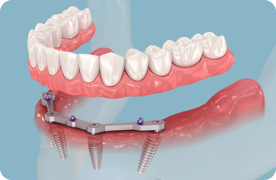 prothese sur implant lyonProthèse amovible complète stabilisée sur implants ( PACSI)Chirurgiens-dentistes Lyon 3 |   Cabinet Lumière